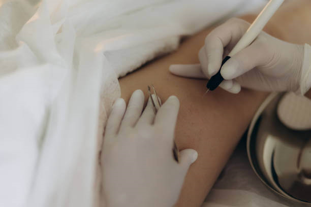 Professional electrolysis treatment in progress at Art of Electrolysis clinic for permanent hair removal.