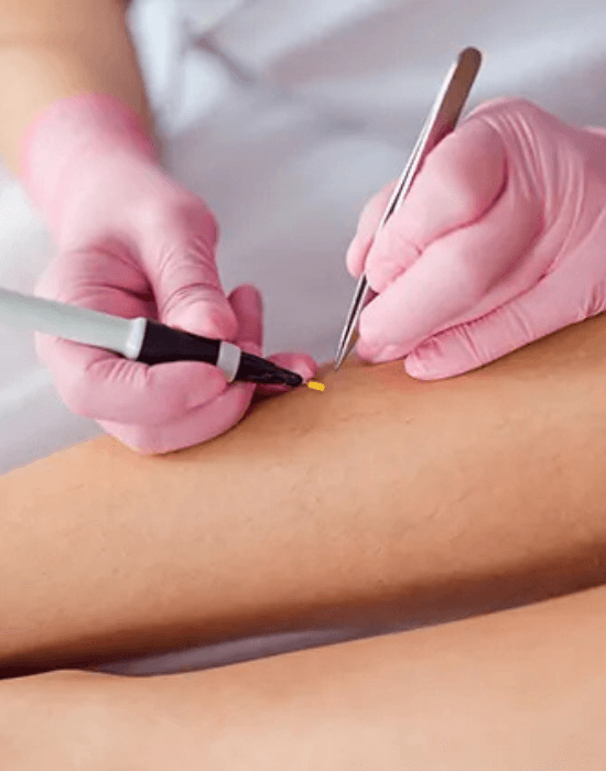 Professional electrolysis treatment in progress at Art of Electrolysis clinic for permanent hair removal.